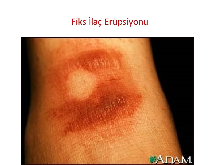 Fiks İlaç Erüpsiyonu 