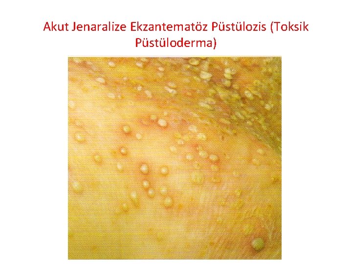 Akut Jenaralize Ekzantematöz Püstülozis (Toksik Püstüloderma) 