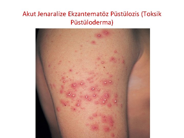 Akut Jenaralize Ekzantematöz Püstülozis (Toksik Püstüloderma) 