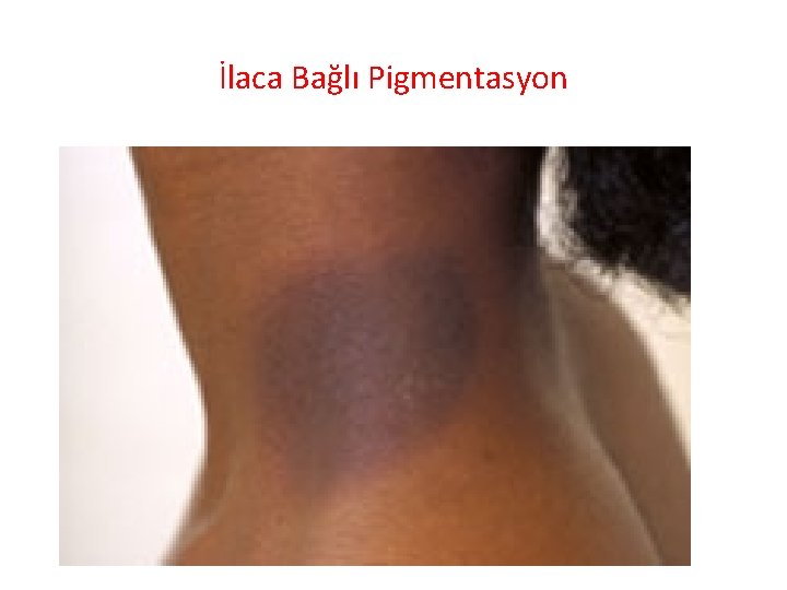 İlaca Bağlı Pigmentasyon 