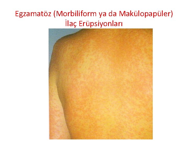 Egzamatöz (Morbiliform ya da Makülopapüler) İlaç Erüpsiyonları 