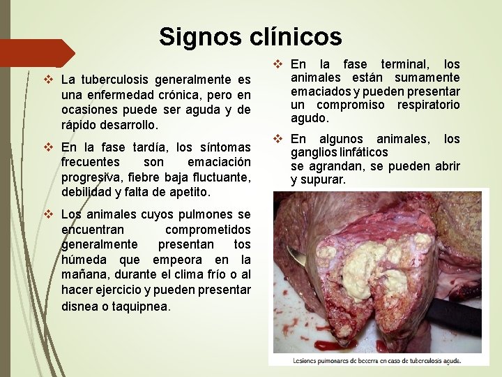 Signos clínicos v La tuberculosis generalmente es una enfermedad crónica, pero en ocasiones puede