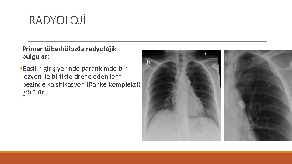 RADYOLOJİ Primer tüberkülozda radyolojik bulgular: • Basilin giriş yerinde parankimde bir lezyon ile birlikte