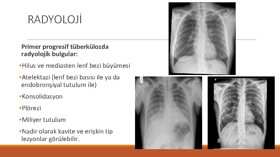 RADYOLOJİ Primer progresif tüberkülozda radyolojik bulgular: • Hilus ve mediasten lenf bezi büyümesi •