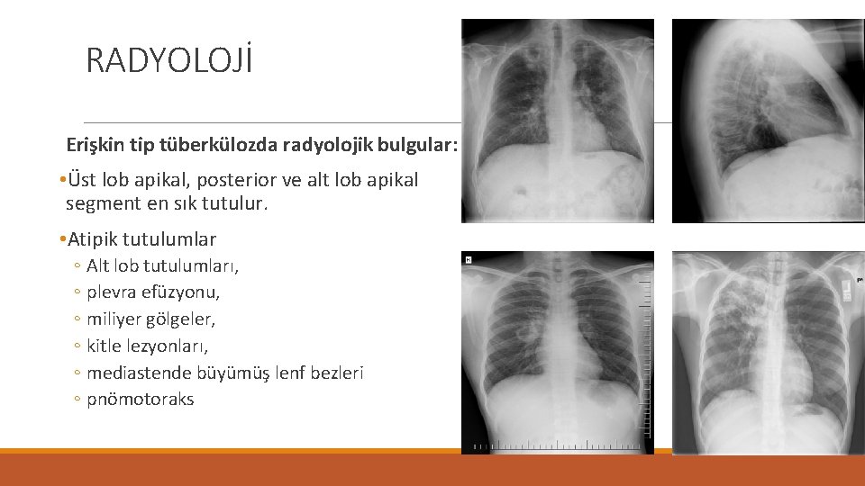 RADYOLOJİ Erişkin tip tüberkülozda radyolojik bulgular: • Üst lob apikal, posterior ve alt lob