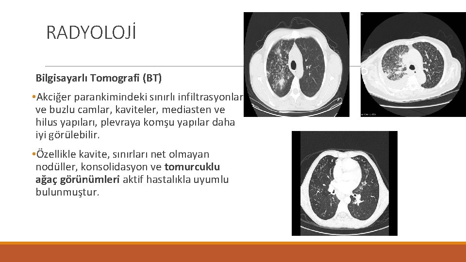 RADYOLOJİ Bilgisayarlı Tomografi (BT) • Akciğer parankimindeki sınırlı infiltrasyonlar ve buzlu camlar, kaviteler, mediasten