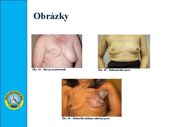 Obrázky Obr. 14 – Stav po mastectomii Obr. 15 – Rekonstrukce prsu Obr. 16