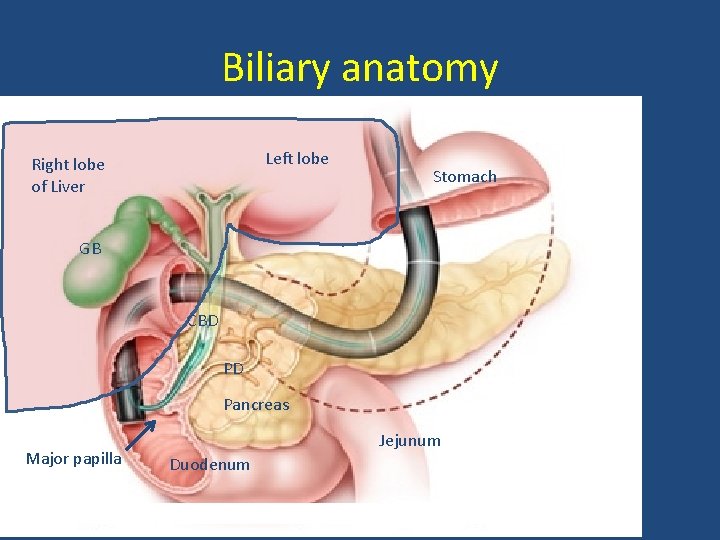 Biliary anatomy Left lobe Right lobe of Liver Stomach GB CBD PD Pancreas Major