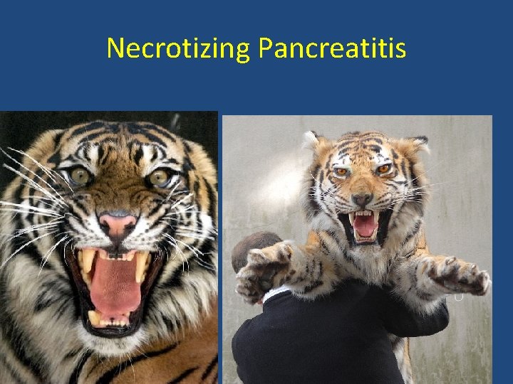 Necrotizing Pancreatitis 