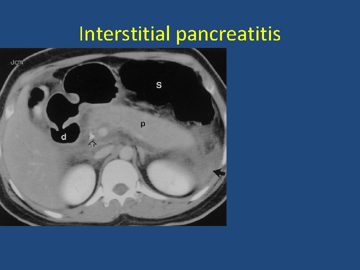 Interstitial pancreatitis 