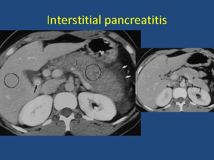 Interstitial pancreatitis 