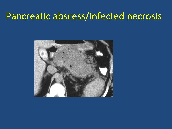 Pancreatic abscess/infected necrosis 