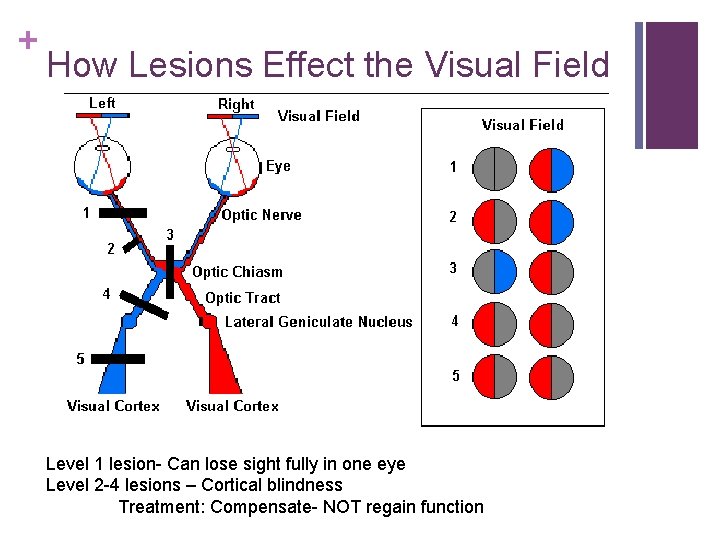 + How Lesions Effect the Visual Field Level 1 lesion- Can lose sight fully