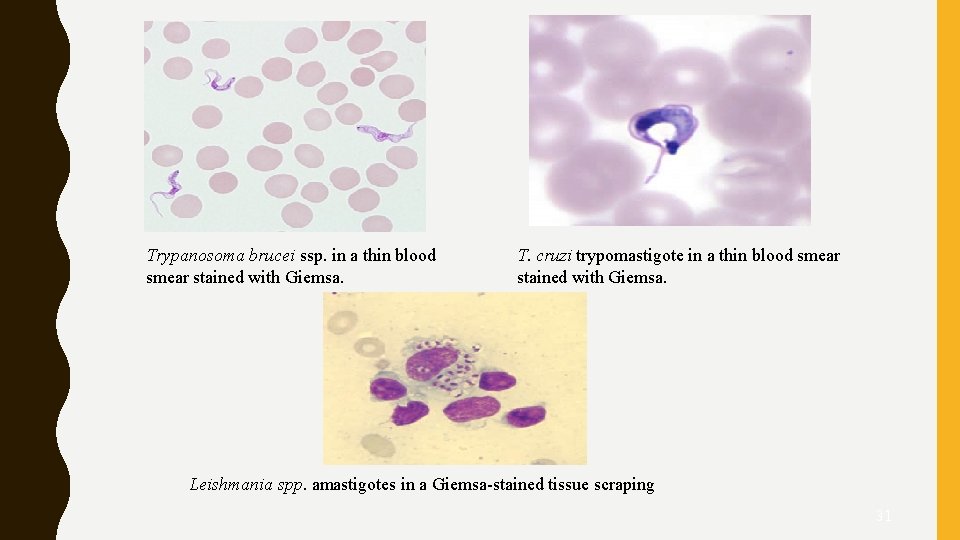 Trypanosoma brucei ssp. in a thin blood smear stained with Giemsa. T. cruzi trypomastigote