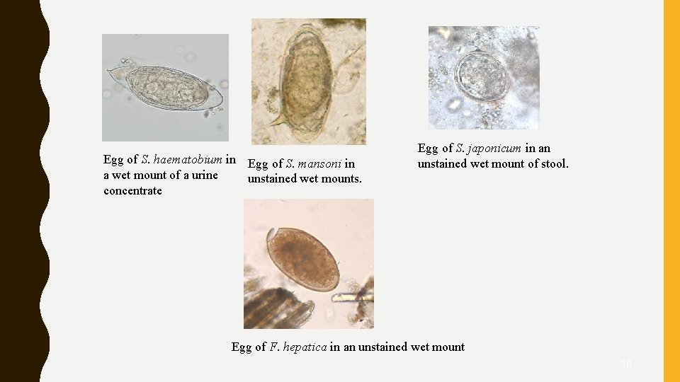 Egg of S. haematobium in Egg of S. mansoni in a wet mount of