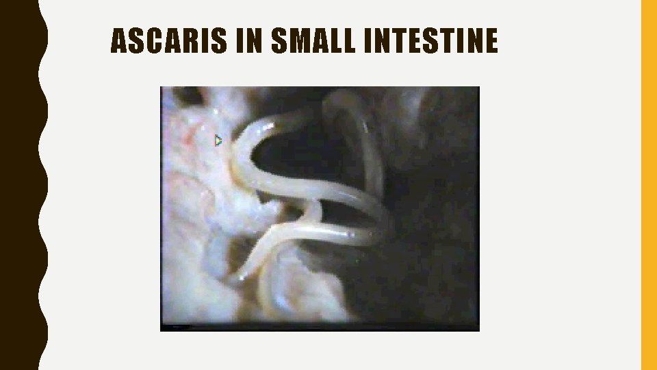 ASCARIS IN SMALL INTESTINE 