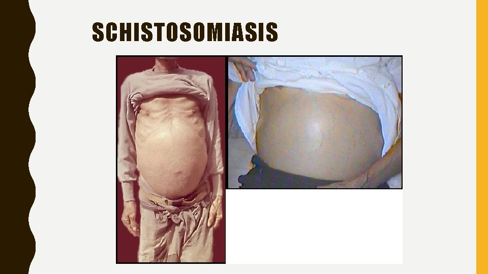 SCHISTOSOMIASIS 