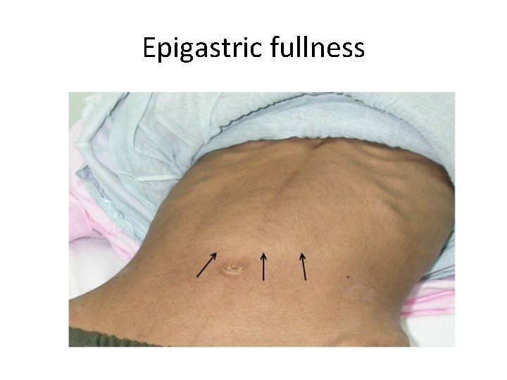 Epigastric fullness 