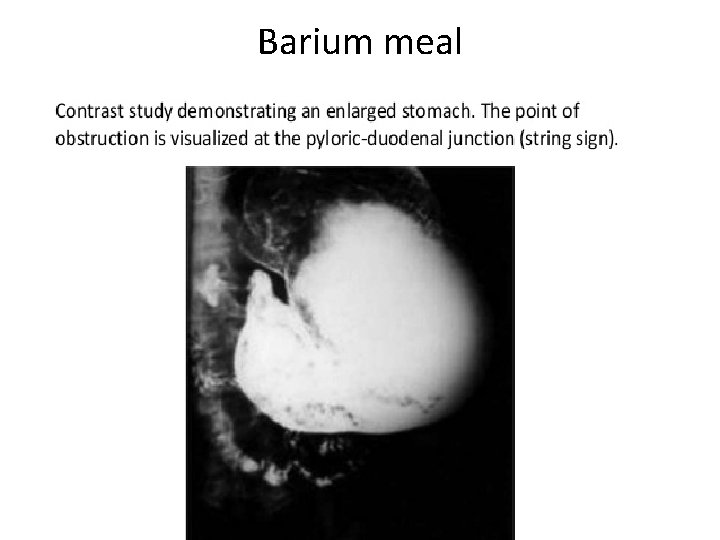 Barium meal 