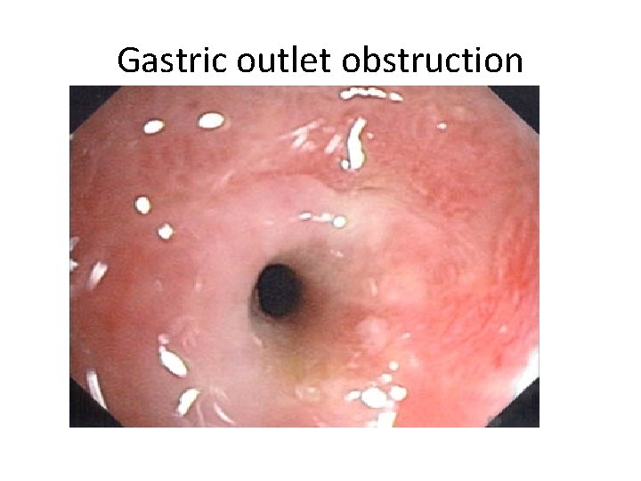 Gastric outlet obstruction 