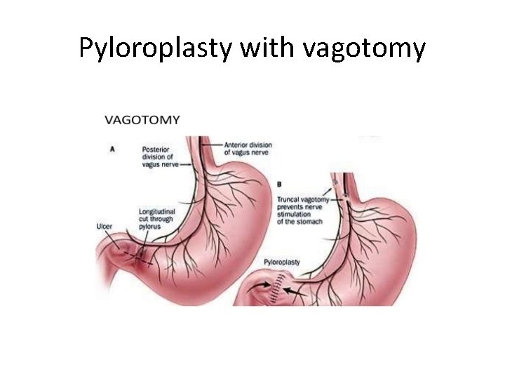 Pyloroplasty with vagotomy 