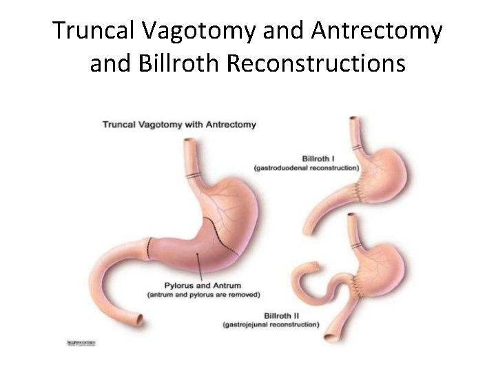 Truncal Vagotomy and Antrectomy and Billroth Reconstructions 