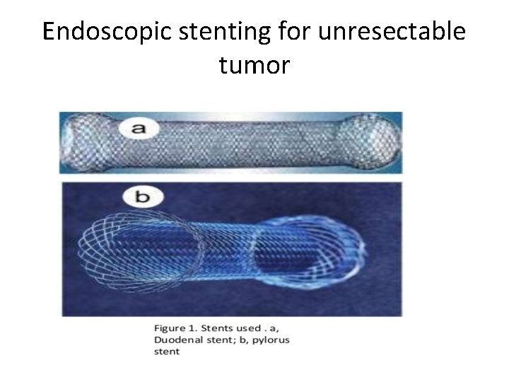 Endoscopic stenting for unresectable tumor 