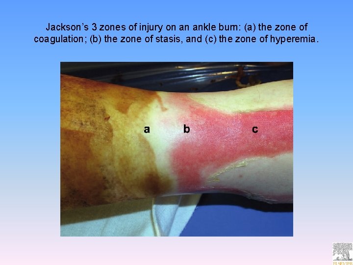 Jackson’s 3 zones of injury on an ankle burn: (a) the zone of coagulation;