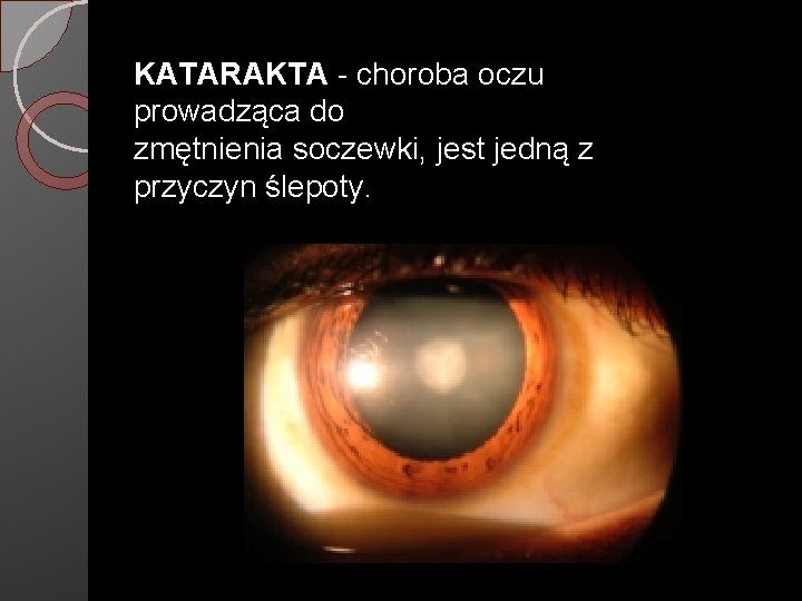 KATARAKTA - choroba oczu prowadząca do zmętnienia soczewki, jest jedną z przyczyn ślepoty. 