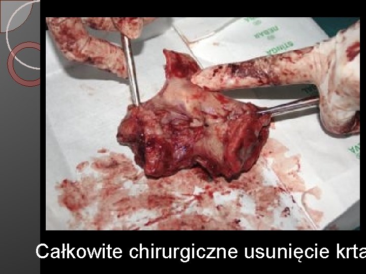 Całkowite chirurgiczne usunięcie krta 