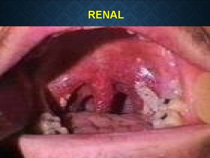 RENAL 