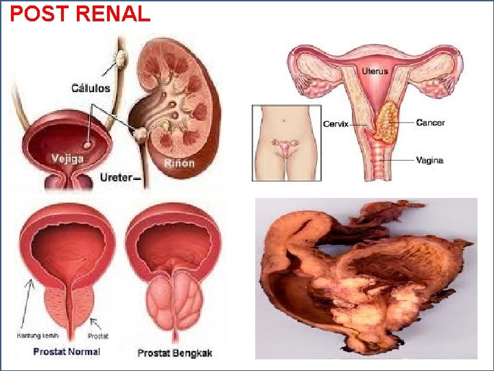 POST RENAL 