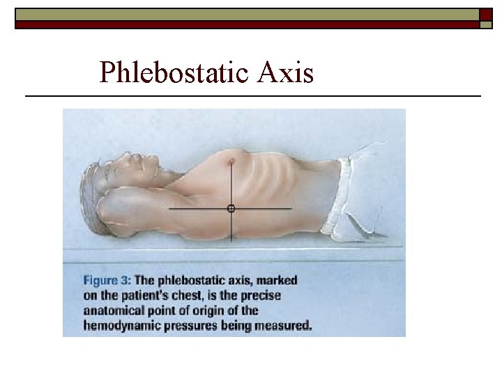 Phlebostatic Axis 