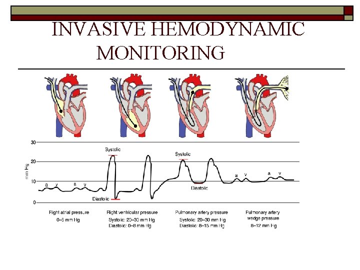 INVASIVE HEMODYNAMIC MONITORING 