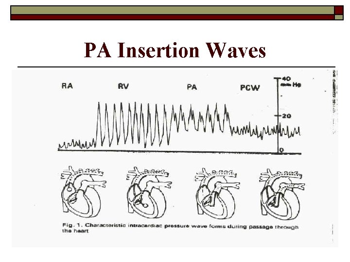 PA Insertion Waves 