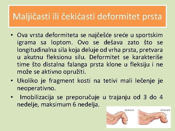 Maljičasti ili čekićasti deformitet prsta • Ova vrsta deformiteta se najčešće sreće u sportskim