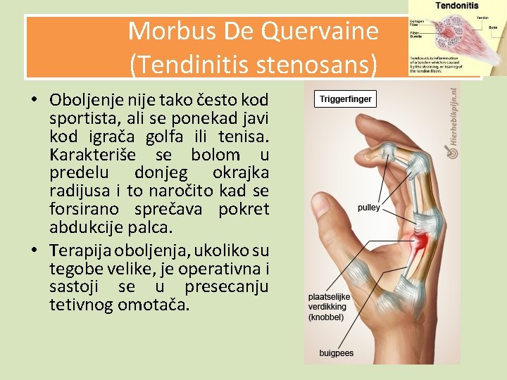 Morbus De Quervaine (Tendinitis stenosans) • Oboljenje nije tako često kod sportista, ali se