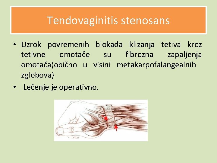 Tendovaginitis stenosans • Uzrok povremenih blokada klizanja tetiva kroz tetivne omotače su fibrozna zapaljenja