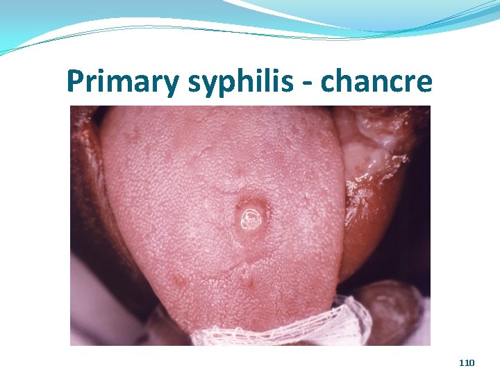 Primary syphilis - chancre 110 