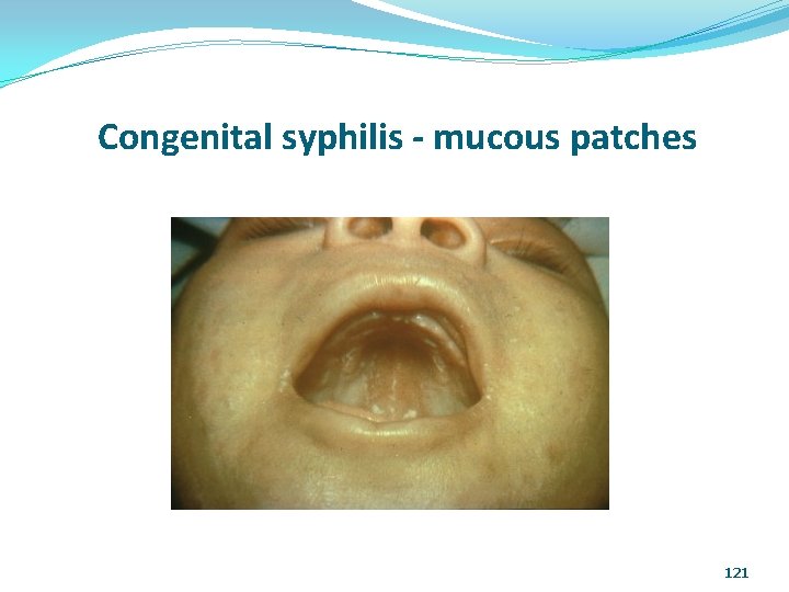 Congenital syphilis - mucous patches 121 