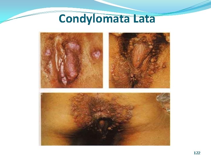 Condylomata Lata 122 