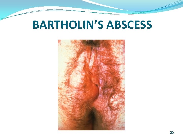 BARTHOLIN’S ABSCESS 20 