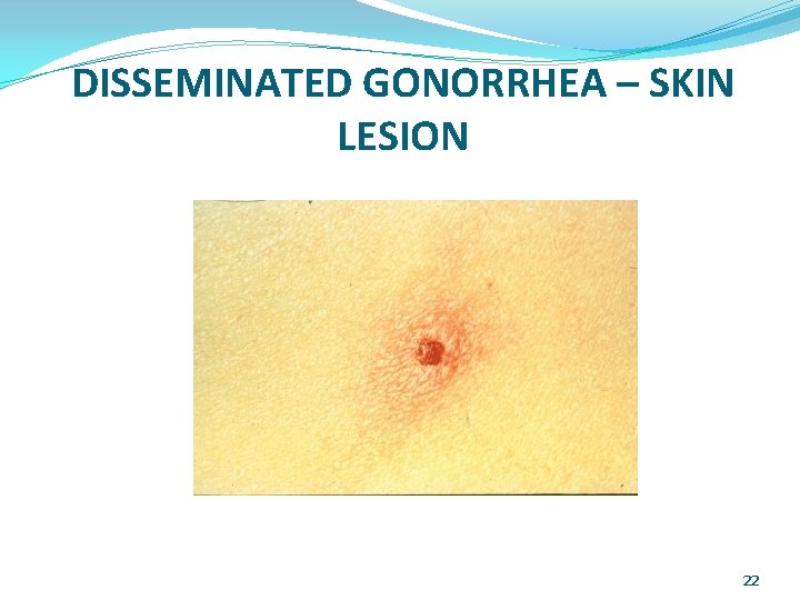 DISSEMINATED GONORRHEA – SKIN LESION 22 