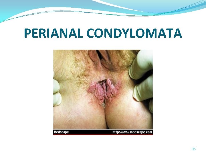 PERIANAL CONDYLOMATA 35 