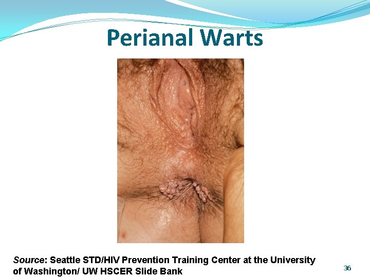 Perianal Warts Source: Seattle STD/HIV Prevention Training Center at the University of Washington/ UW
