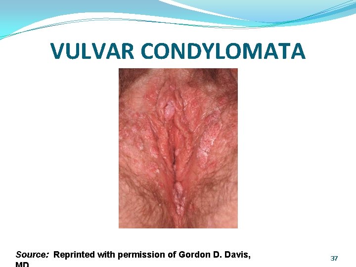 VULVAR CONDYLOMATA Source: Reprinted with permission of Gordon D. Davis, 37 