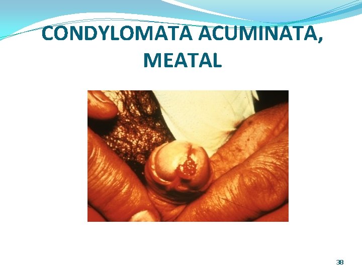 CONDYLOMATA ACUMINATA, MEATAL 38 