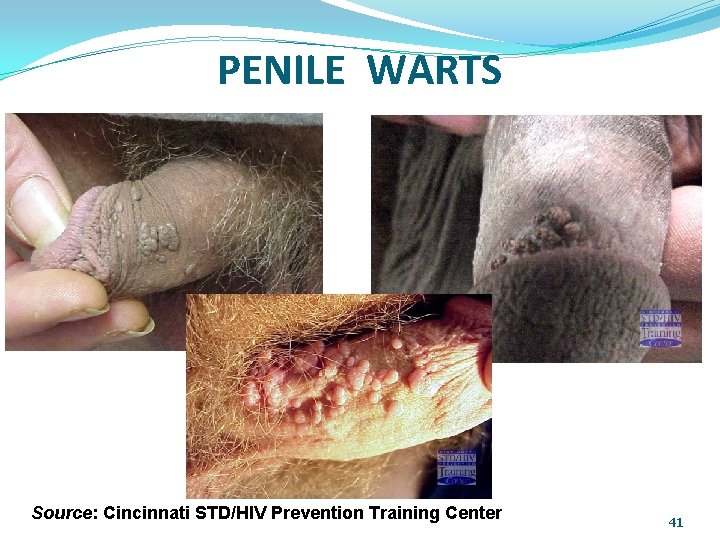 PENILE WARTS Source: Cincinnati STD/HIV Prevention Training Center 41 