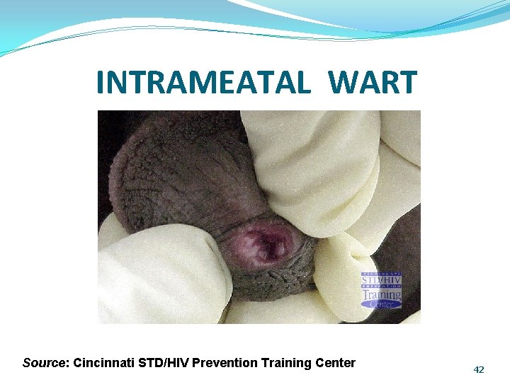 INTRAMEATAL WART Source: Cincinnati STD/HIV Prevention Training Center 42 