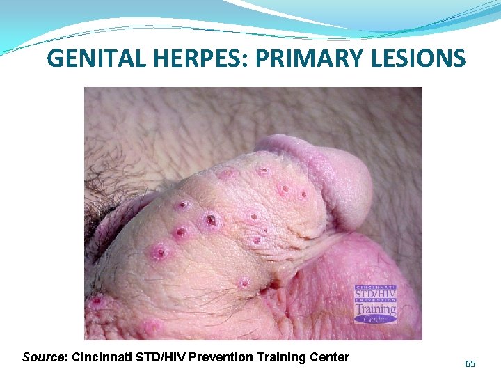GENITAL HERPES: PRIMARY LESIONS Source: Cincinnati STD/HIV Prevention Training Center 65 